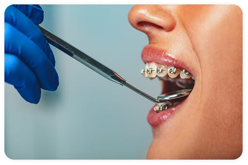Metal Braces
